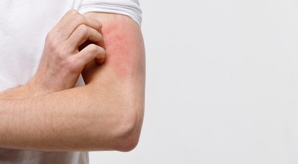 13 Penyebab Kulit Gatal Bentol Seperti Digigit Nyamuk